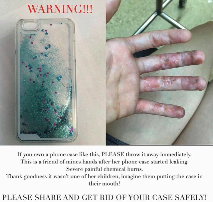 【注意】液体入りのiPhoneケース（キラキラケース）で事故多発！液体が漏れて化学熱傷の被害
